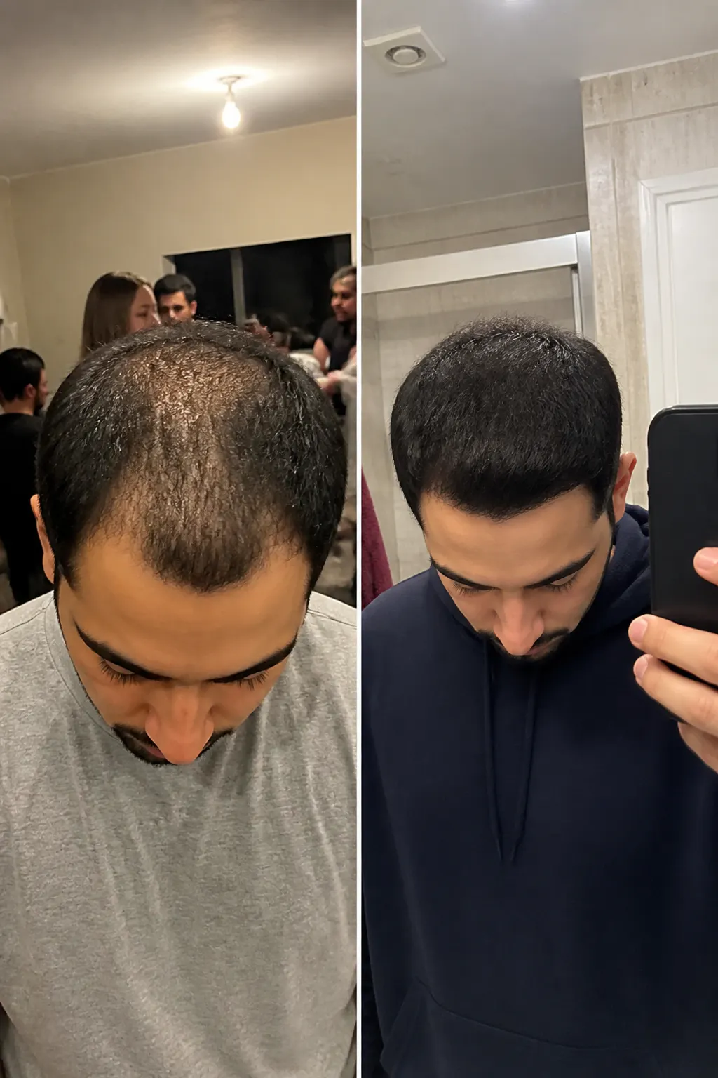 Before and after scalp result - Marcus, 29