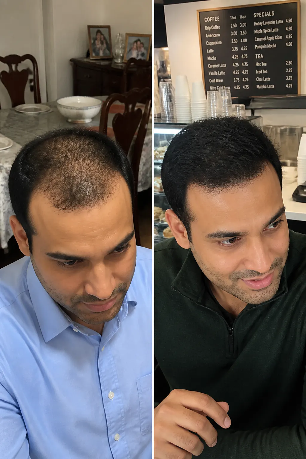 Before and after scalp result - Devon, 34