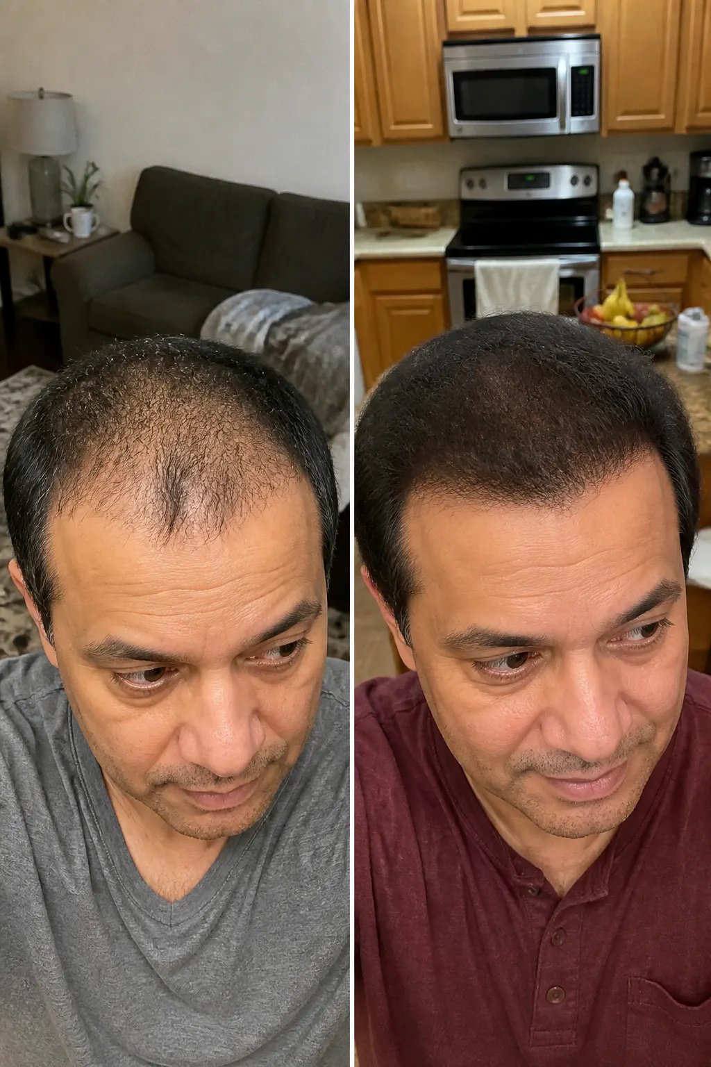Before and after scalp result - Tyler, 27