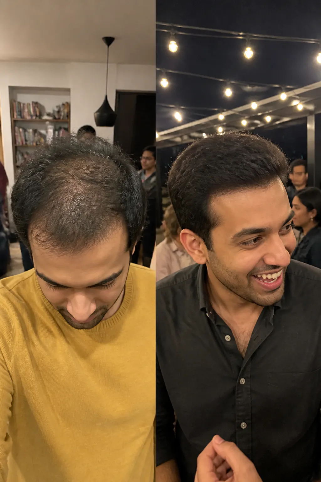 Before and after scalp result - Jamal, 31